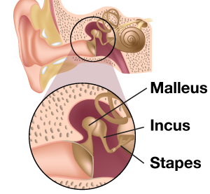 The Stapes in Otosclerosis: Osteoarthritis of an Ear Ossicle