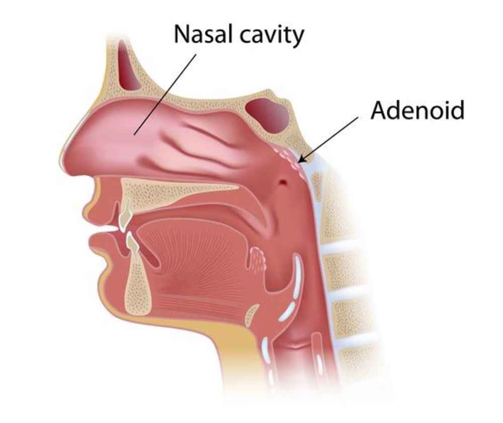 Tonsillectomy and Adenoidectomy - Owings Mills, MD
